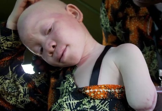 Bambino albino mutilato