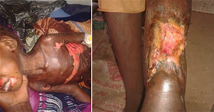 Bambini feriti da armi chimiche in Darfur (Courtesy Amnesty International)