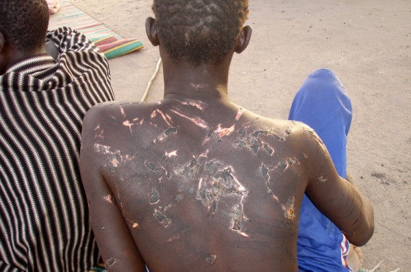 ragazzo sud-sudanese con segni di tortura