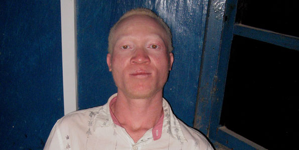 L'albino (zeruzeru in lingua swahili) Robinson Mkwama salvato dalla polizia in Tanzania