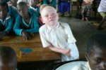 bambino-albino-mutilato